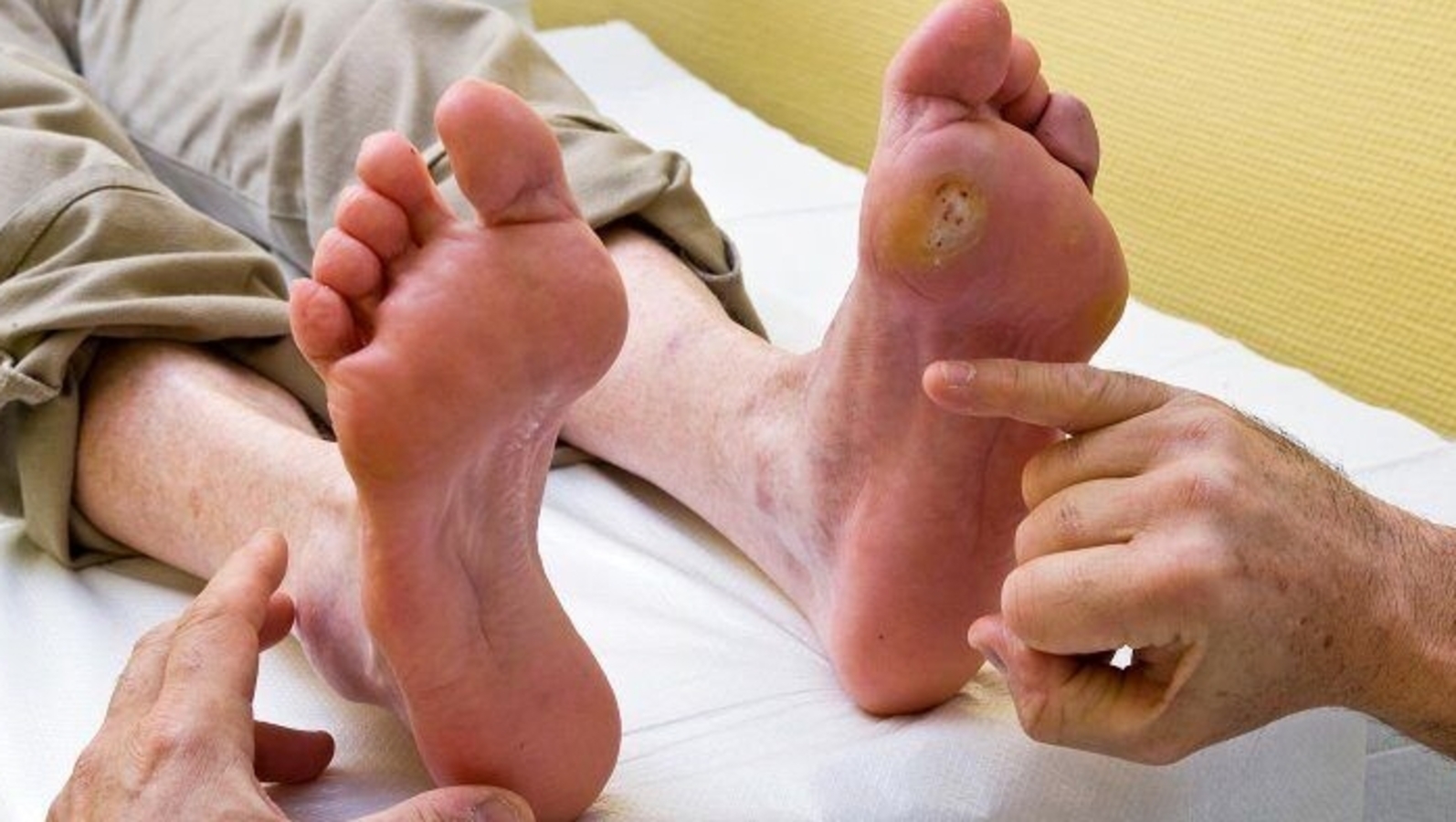 5 Cara Menghindari Luka di Kaki untuk Penderita Diabetes